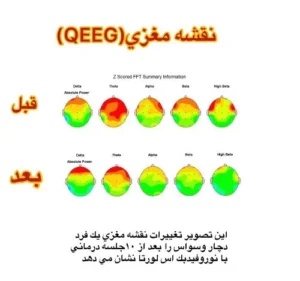 فواید qEEG