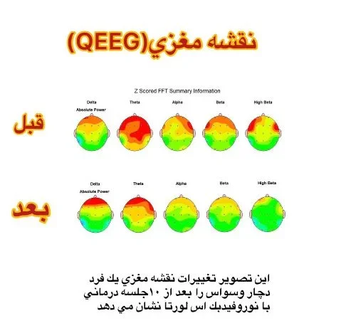 فواید qEEG