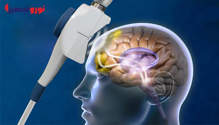 تحریک مغناطیسی مغز TMS